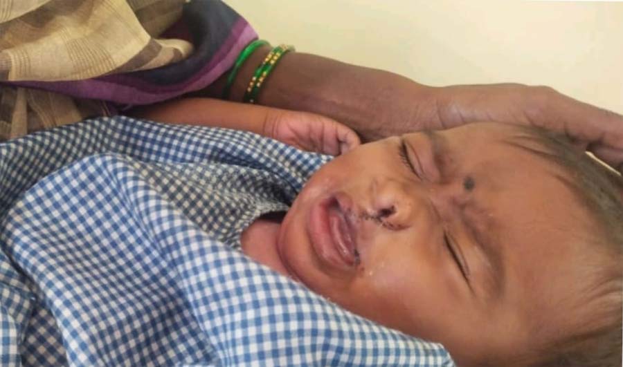 रायपुर : चिरायु योजना बनी बच्चों के लिए संजीवनी