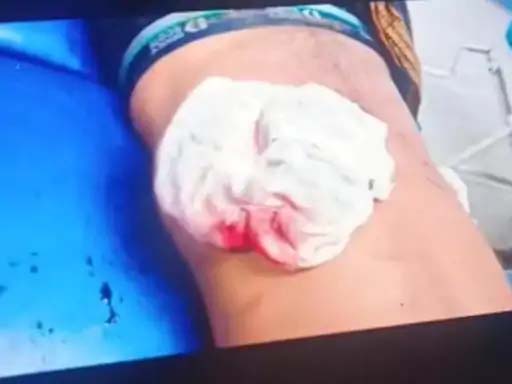 कोरबा: इमलीडुग्गू में चाकू और सर्जिकल ब्लेड से हमला, चार लोग गंभीर रूप से घायल, नशेड़ी युवकों ने दिया वारदात को अंजाम, 7 आरोपियों के खिलाफ केस दर्ज, तलाश जारी