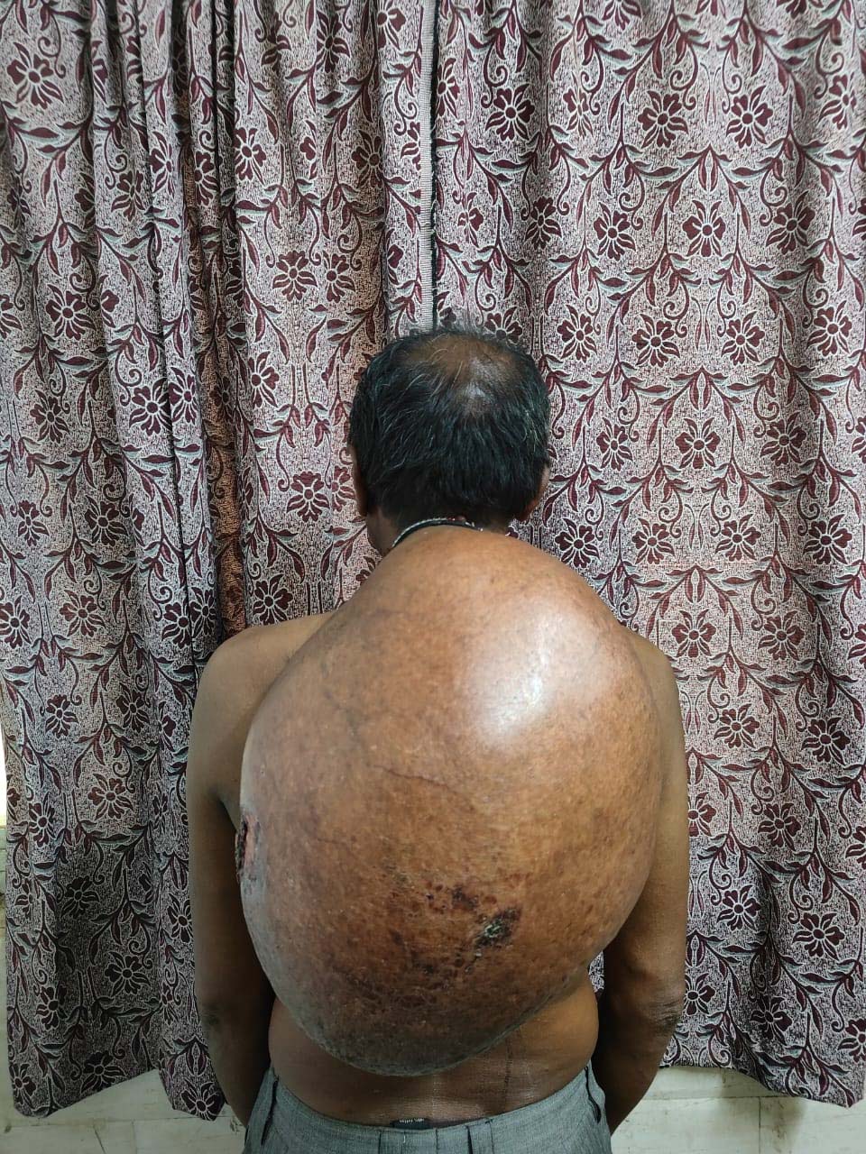 रायपुर : अम्बेडकर अस्पताल के सर्जरी विभाग की ऐतिहासिक उपलब्धि : 10.30 किलोग्राम वजनी विशाल ट्यूमर का सफल ऑपरेशन