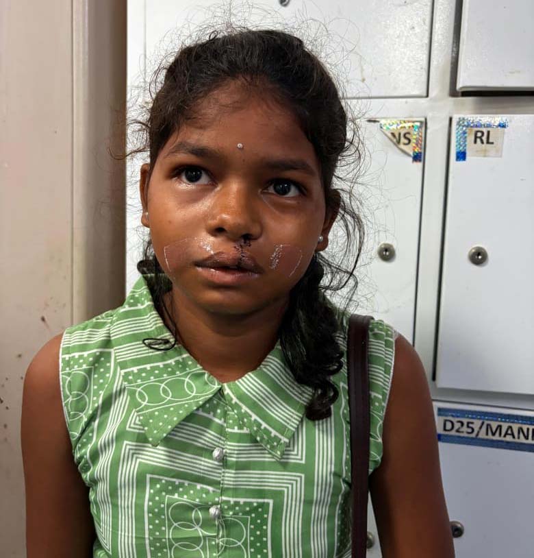 रायपुर : कटे होंठ से टूटी हिम्मत तक… एक ऑपरेशन और बदल गई जिंदगी