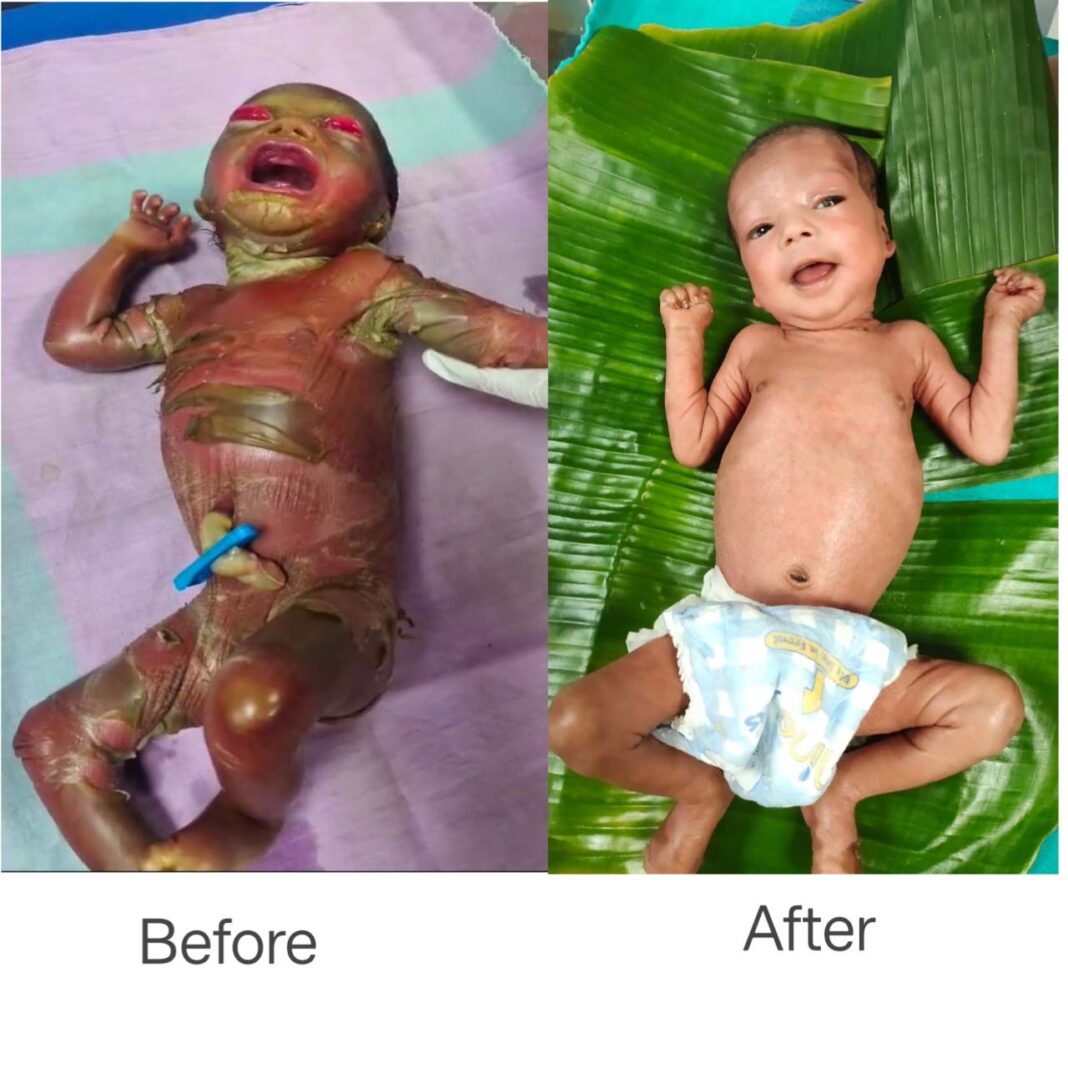 रायपुर : सुदूर बीजापुर में चिकित्सा चमत्कार : अत्यंत दुर्लभ बीमारी से जूझते शिशु को बचाया