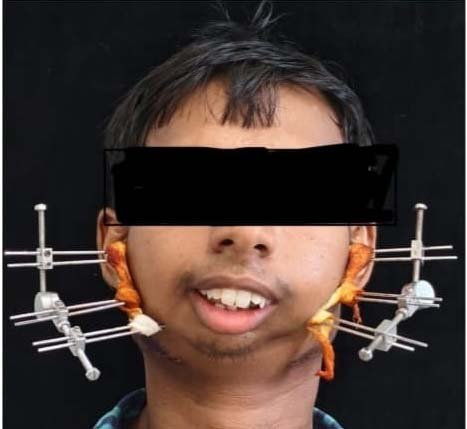 रायपुर : जटिल सर्जरी से खुला मुंह, आयुष्मान योजना से मिला निःशुल्क उपचार
