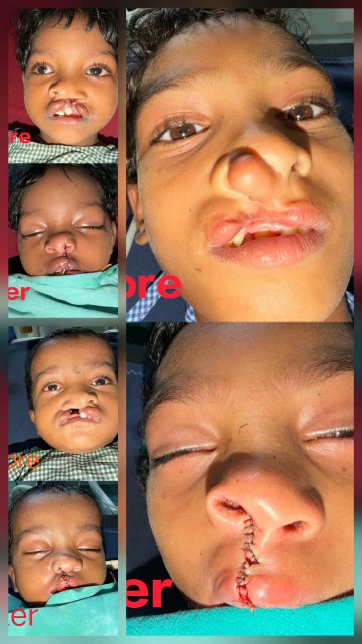 रायपुर : चिरायु योजना से जन्मजात समस्या से मिली राहत, तीन बच्चों के चेहरों पर लौटी मुस्कान