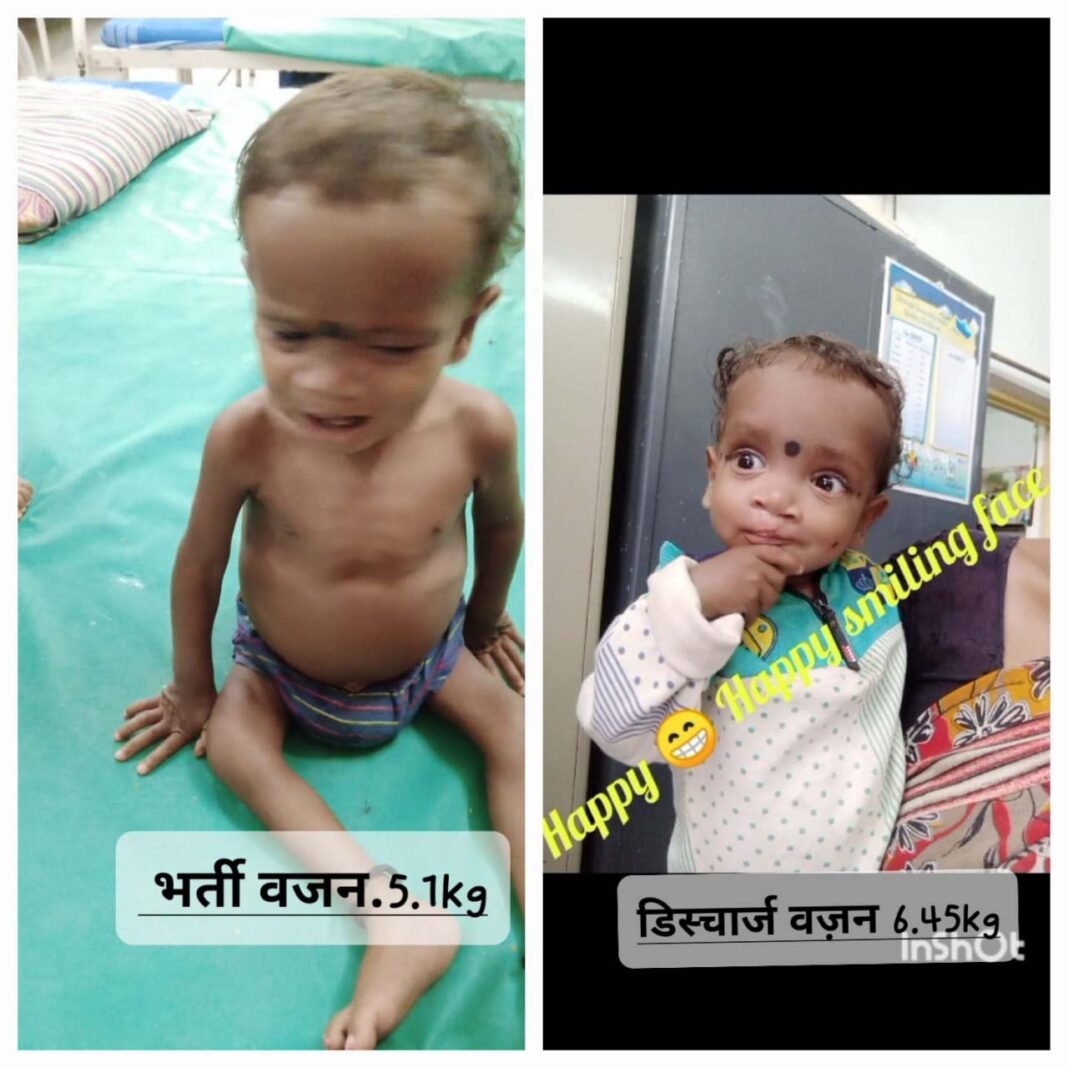 रायपुर : सेवा की कहानी : पोषण पुनर्वास केंद्र ने ओमेश को कुपोषण से उबारा, अब स्वस्थ होकर लौटा घर